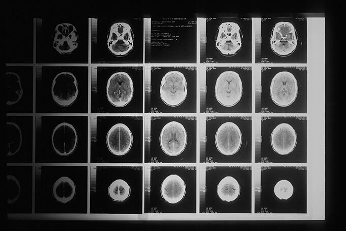 医療 看護 介護 無料 写真 イラスト 素材 著作権フリー  人体 臓器 Organs 解剖生理 Anatomical physiology 脳 brain CT フィルム