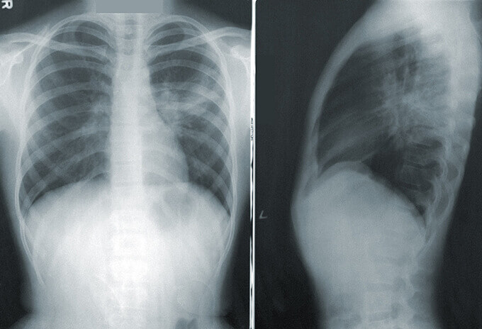 医療 看護 介護 無料 写真 イラスト 素材 著作権フリー  人体 臓器 Organs 解剖生理 Anatomical physiology 肺 Lung 胸部レントゲン Chest X-ray 胸写